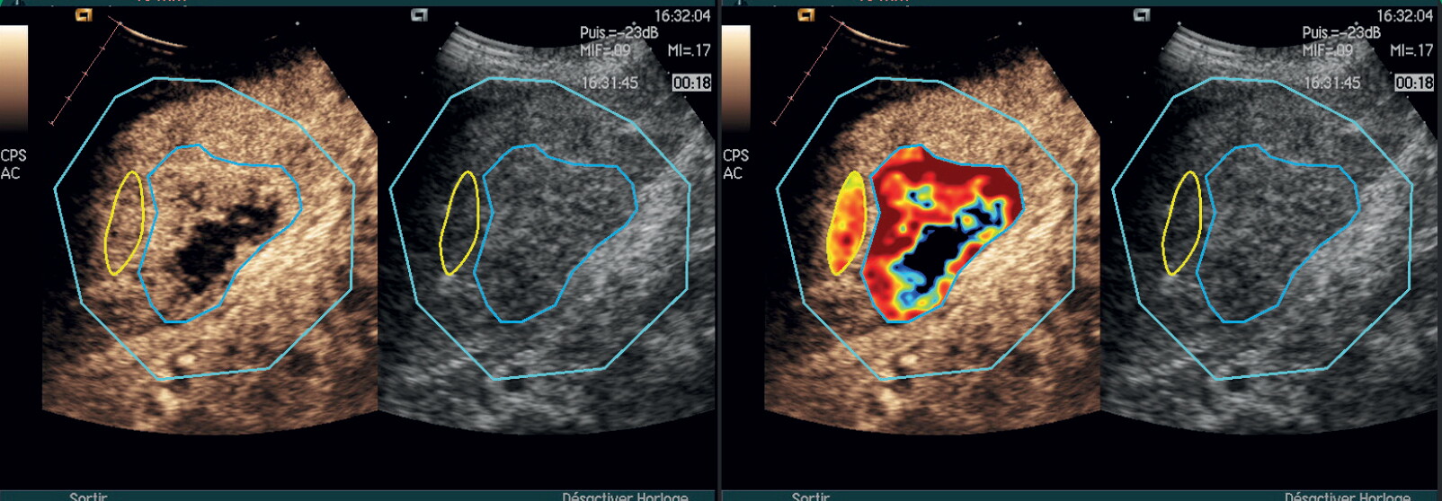 Screen capture of the VueBox® quadrant view during a bolus analysis